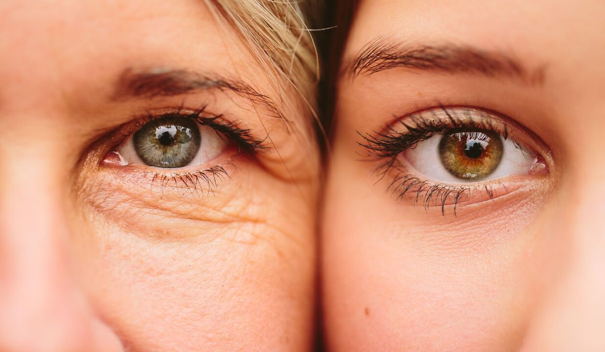 علامات الشيخوخة حول العينين